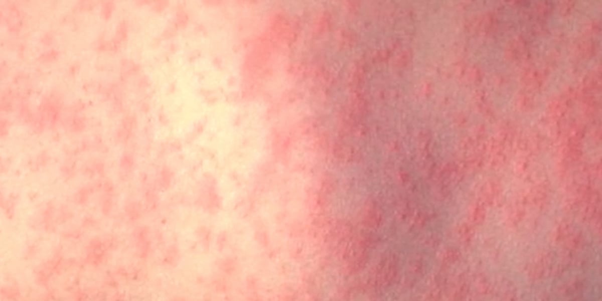 New case of measles reported at school in St. Petersburg