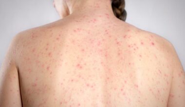 Measles case confirmed at St. Petersburg Catholic High; classes to continue 'as normal'