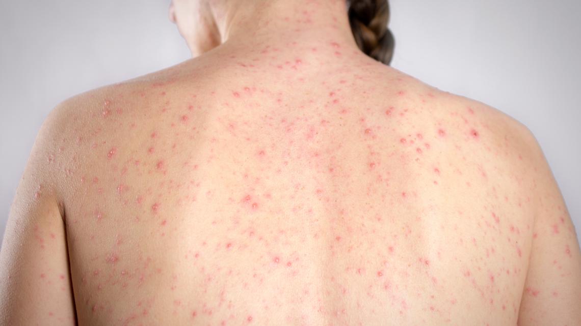 Measles case confirmed at St. Petersburg Catholic High; classes to continue 'as normal'