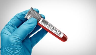 Florida measles cases jump almost 25% in a week, making it the state with the 3rd most in the country