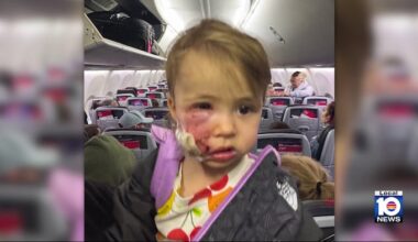 Toddler recovering after dog attack at Miami Beach park