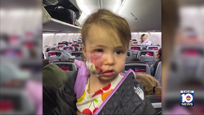 Toddler recovering after dog attack at Miami Beach park