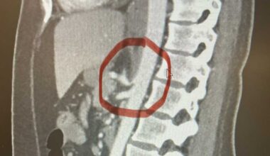 Median Arcuate Ligament Syndrome | Orlando surgeon explains signs, symptoms and treatment