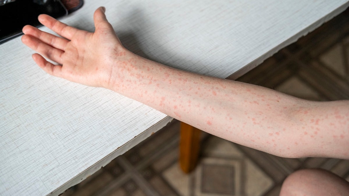 arm with measles