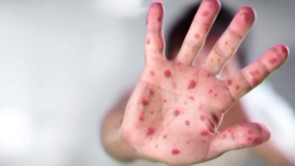 Florida ranks 3rd for the most measles cases in the U.S – NBC 6 South Florida