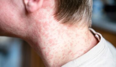 Lee Health confirms one positive test for measles in Lee County | WGCU News