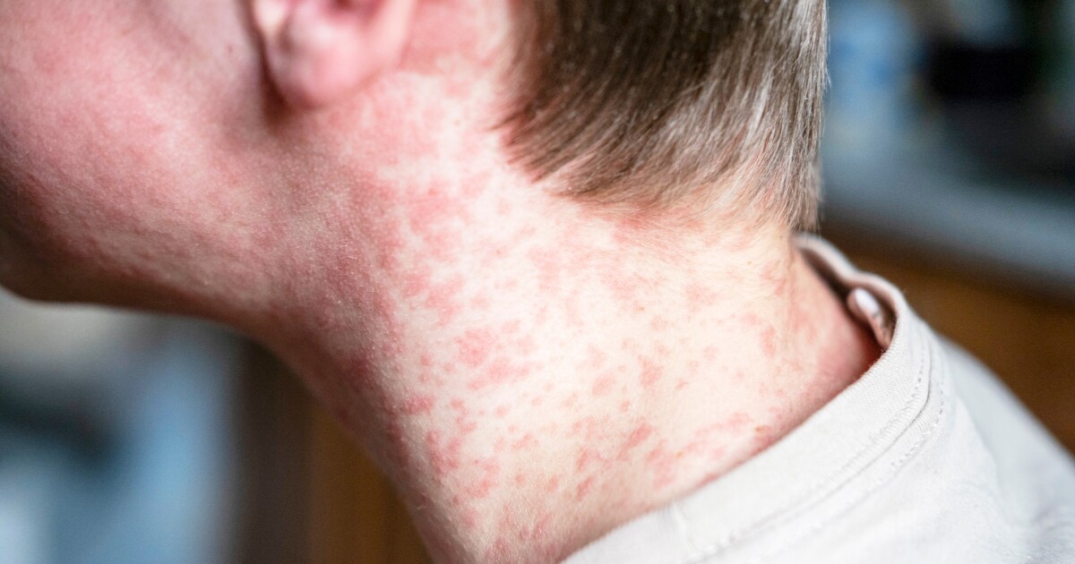 Lee Health confirms one positive test for measles in Lee County | WGCU News