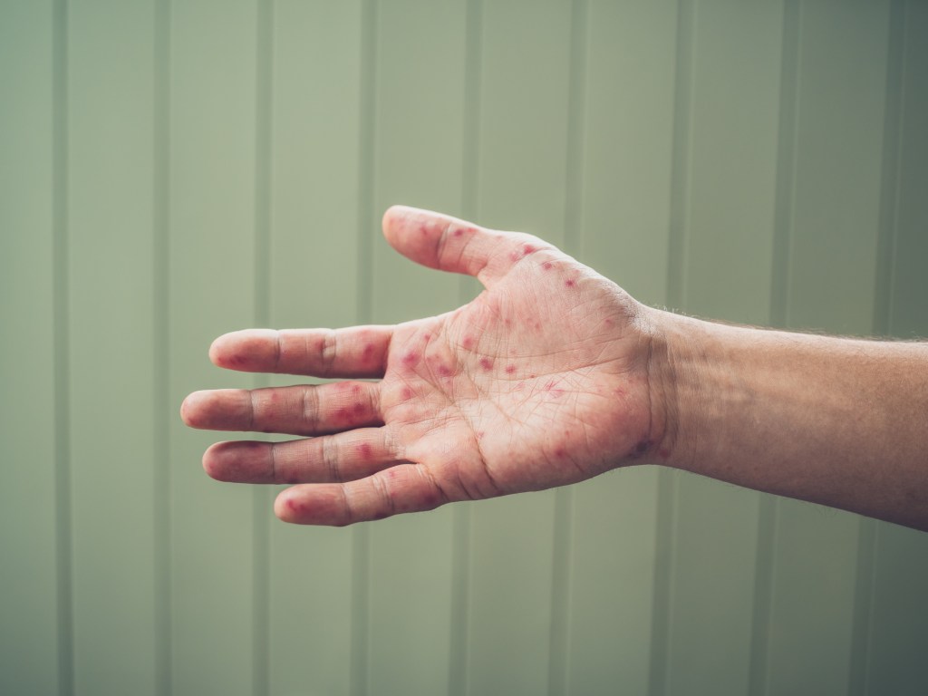 Hand of a young man with a rash from hand, foot, and mouth disease.