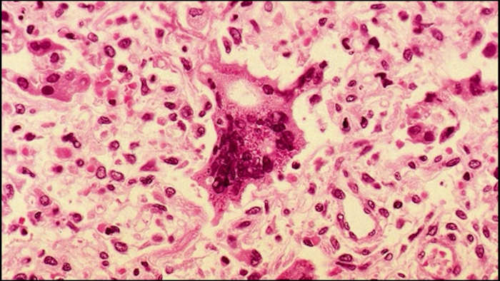 State confirms 1st Central Florida measles case in Osceola County