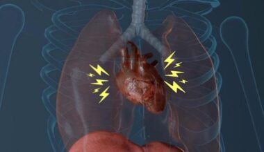 Treating AFib with a single procedure proves to be safer, more effective