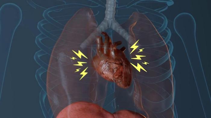 Treating AFib with a single procedure proves to be safer, more effective