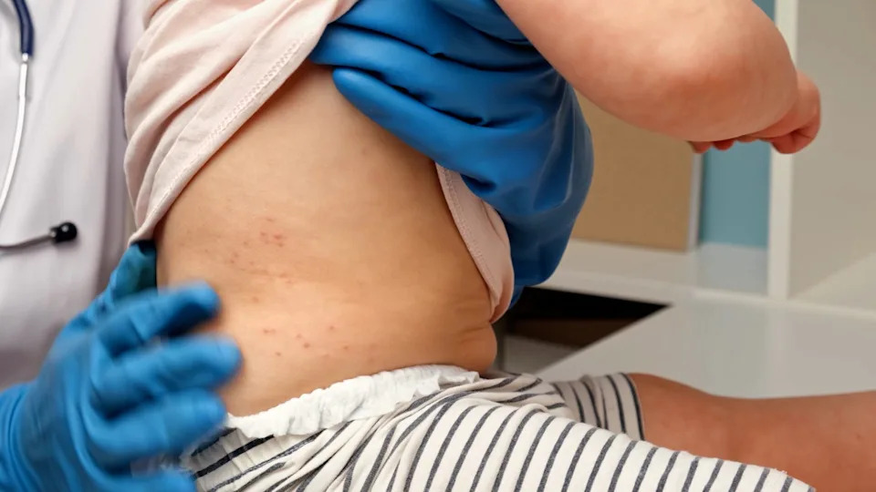 For 2025, more than 2,000 confirmed measles cases were reported in the United States, according to the Centers for Disease Control and Prevention. As of Feb. 19, 2026, nearly 1,000 confirmed measles cases already have been reported since the new year.