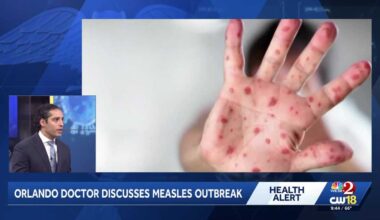Central Florida doctor explains signs, symptoms, likely cause for surge in measles