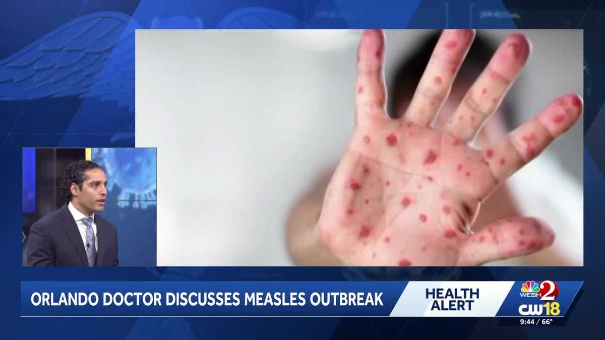 Central Florida doctor explains signs, symptoms, likely cause for surge in measles