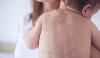 Florida has third most measles cases in US