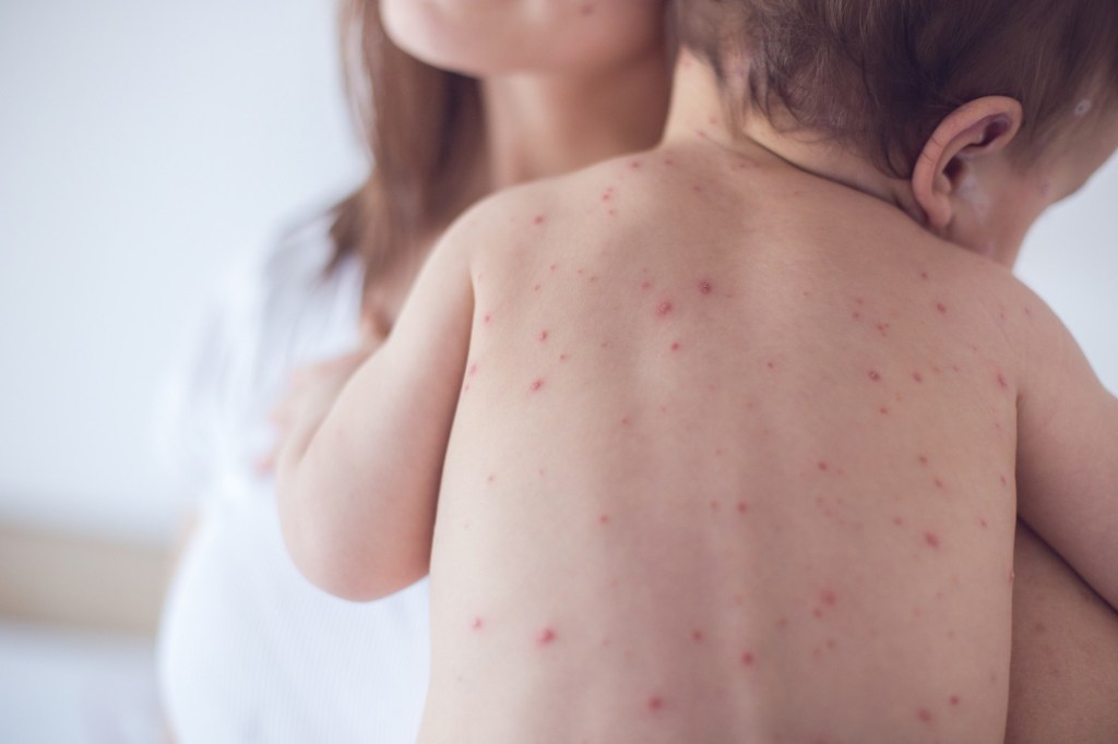 Florida has third most measles cases in US