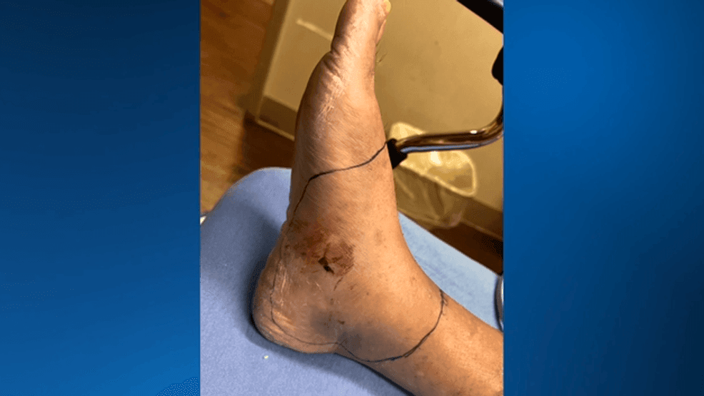 {p}A honeymoon snake bite turned a Florida man’s life into a fight for survival, leaving him with a deadly lung disease and in need of a double transplant. (WWSB){/p}