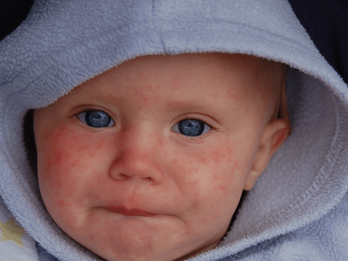 Florida adds more measles cases