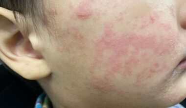 Q&A with Dr. Mobeen Rathore; Florida’s unique case of measles