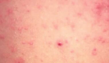 Measles cases stay flat in Florida