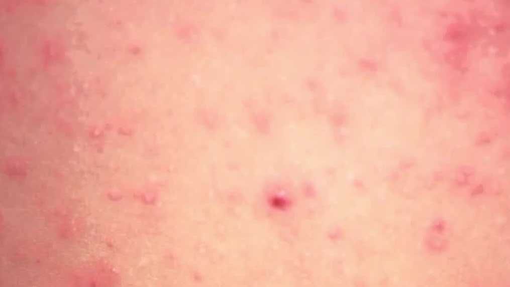 Measles cases stay flat in Florida