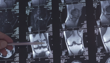 Why young female soccer players are tearing ACLs at alarming rates | Investigations