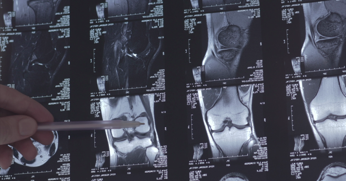 Why young female soccer players are tearing ACLs at alarming rates | Investigations