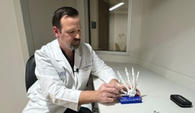 Florida Orthopaedic Institute's thumb prosthesis surgery