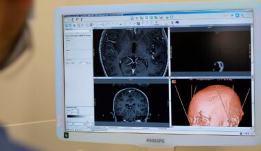 Deep brain stimulation helps South Florida Parkinson's patient regain control after years of tremors