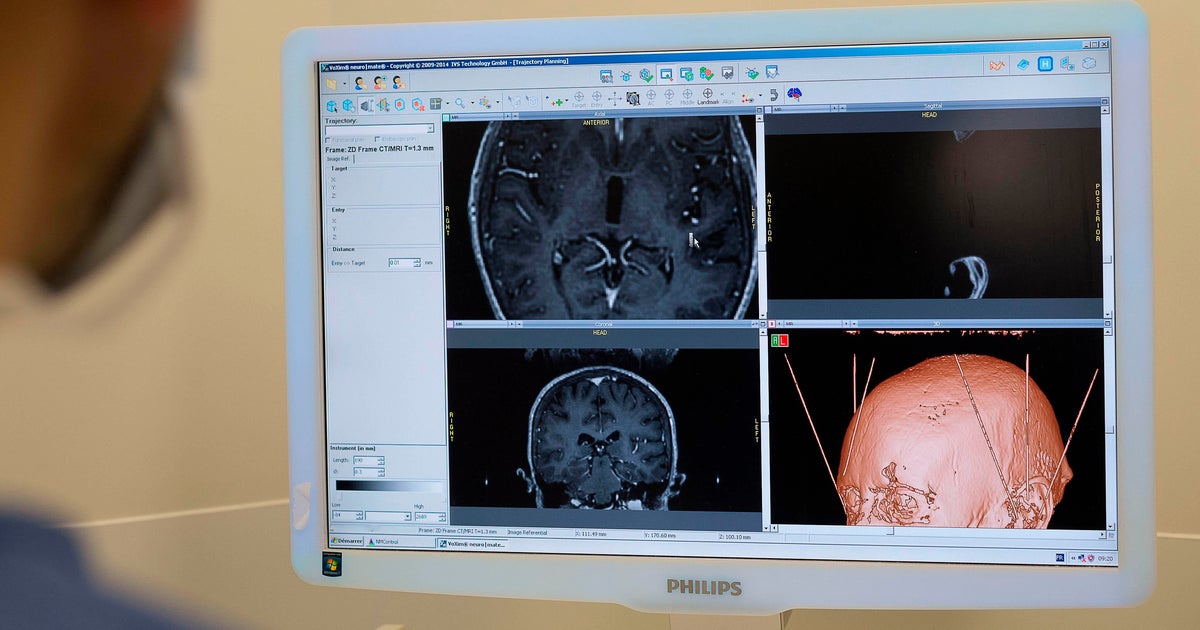 Deep brain stimulation helps South Florida Parkinson's patient regain control after years of tremors