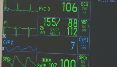 Results from University of Miami study could one day change how people with atrial fibrillation are treated
