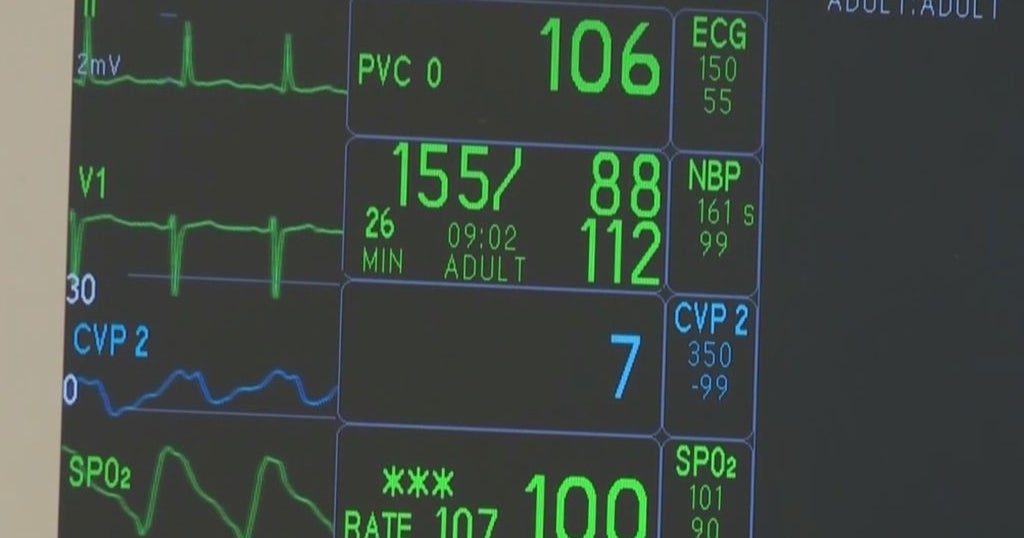 Results from University of Miami study could one day change how people with atrial fibrillation are treated