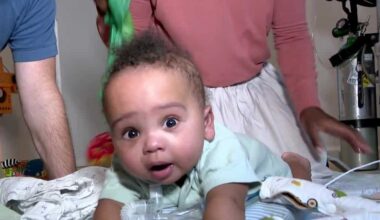 Florida baby born twice after rare surgery