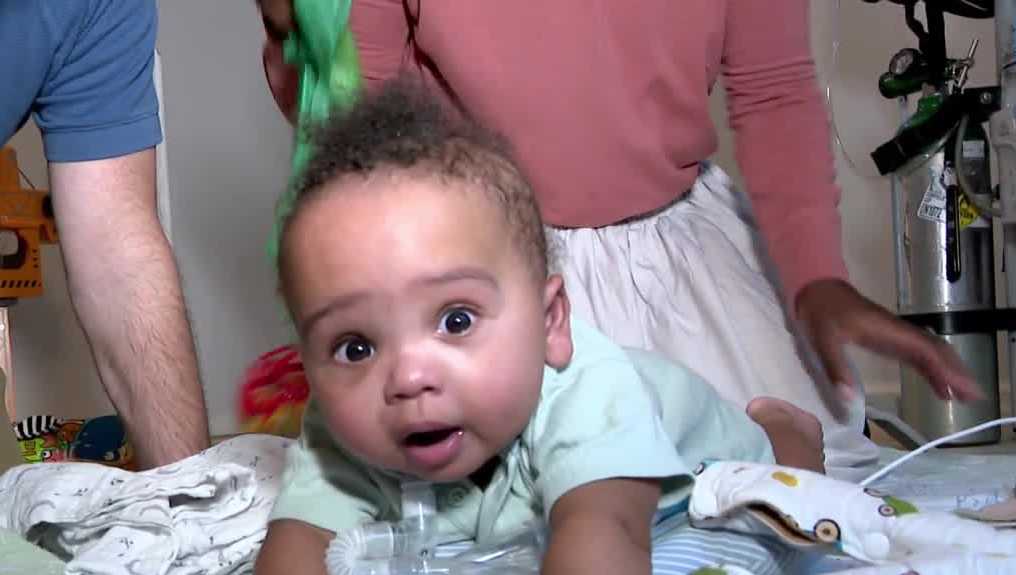 Florida baby born twice after rare surgery