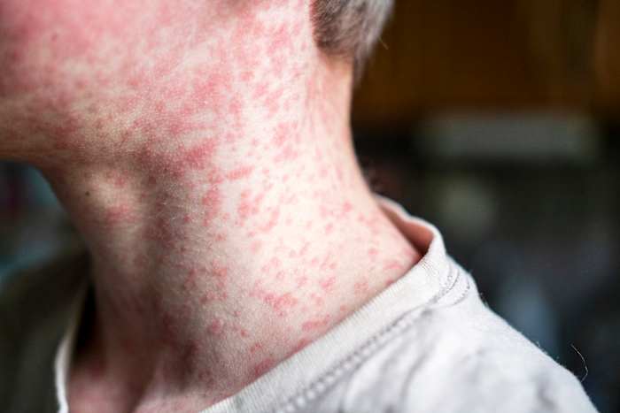 2 measles cases confirmed in Orange County as Florida cases hit 152