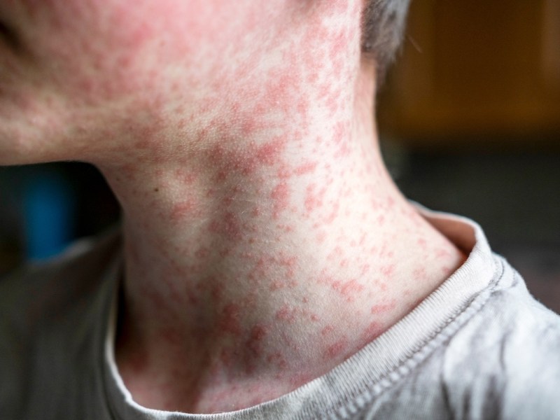 Summer’s coming, and data show Florida measles cases are rising