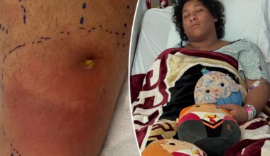 Florida teen 'fighting for his life' from flesh-eating bacteria
