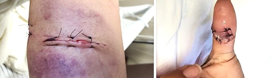 Left: Alea Bates took this photo of her left forearm after surgery. Right: Bates was shot seven times at close range — twice in the back and once each in the pelvis, stomach, left forearm, right thumb and right foot.