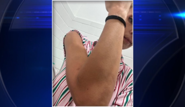 Jackson Memorial Hospital nurse sues hospital, county for $5 million after brutal attack by patient - WSVN 7News | Miami News, Weather, Sports