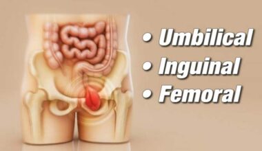 Millions of people have hernias, but most never see a doctor. Why experts say that needs to change