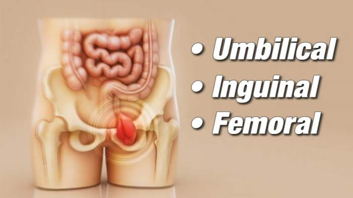 Millions of people have hernias, but most never see a doctor. Why experts say that needs to change