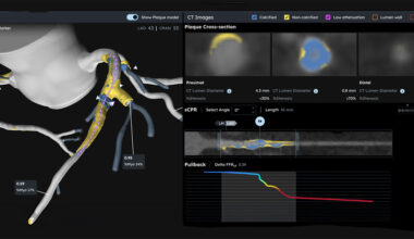 University of Miami First in Florida to Use AI-Powered Heartflow PCI Navigator for Heart Procedures