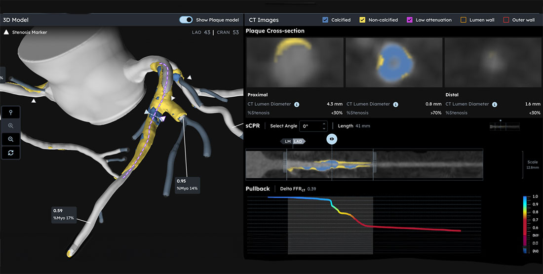 University of Miami First in Florida to Use AI-Powered Heartflow PCI Navigator for Heart Procedures
