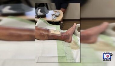 ‘Flesh-eating’ bacteria infections in Florida: 1 dead, 12 confirmed cases, health officials report