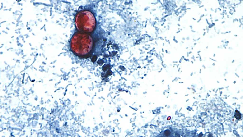 Cyclospora outbreak hits Florida with 60 cases