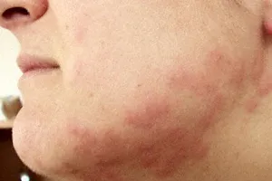 Bedbug bites on a person's jaw line, face and neck.