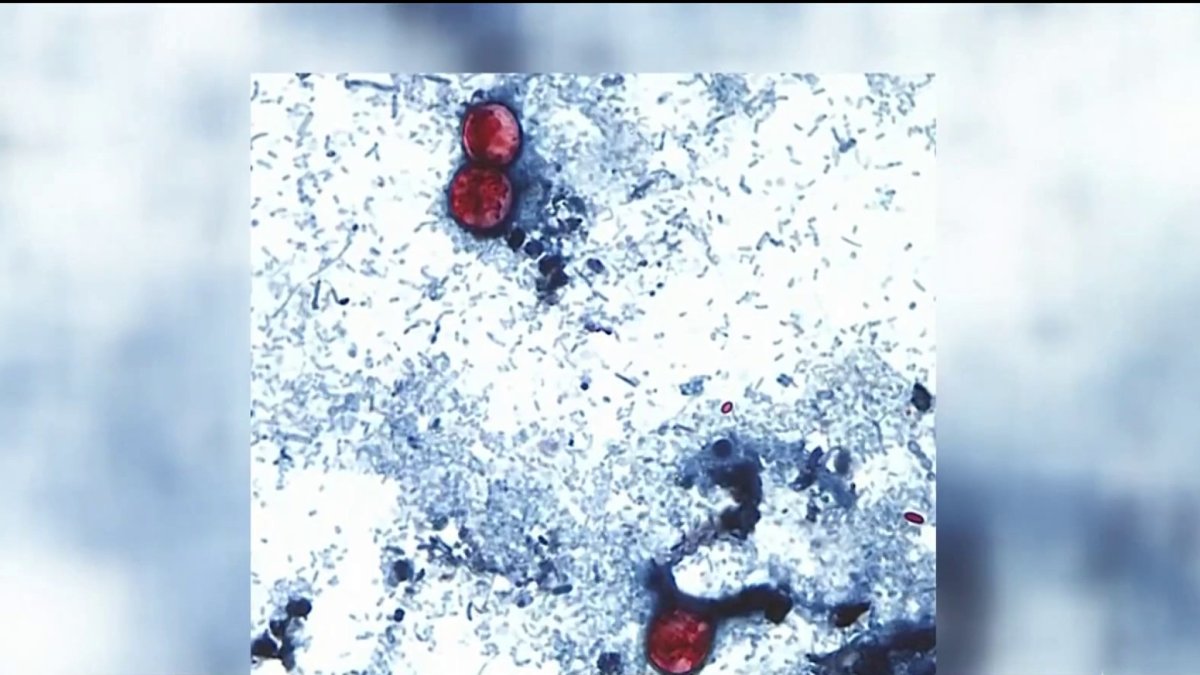 Dozens of cyclosporiasis cases confirmed in Florida including in Miami-Dade and Broward – NBC 6 South Florida
