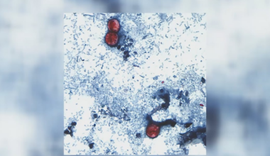 Parasite cases reported in Lee, Hillsborough counties as cyclosporiasis spreads across 17 states