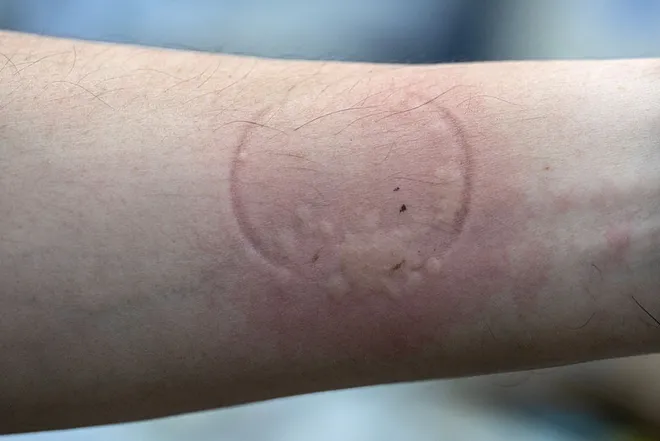 This photo taken on October 8, 2025, shows a researcher displaying rashes after allowing bed bugs to feed on his arm as part of a scientific study.