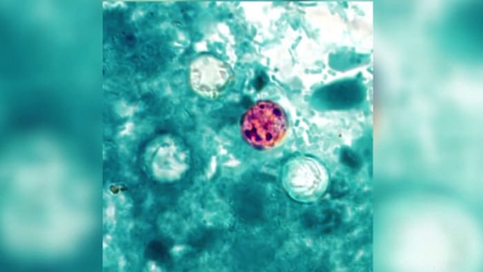 Cyclosporiasis cases in Florida, US could be undercounted, health expert says
